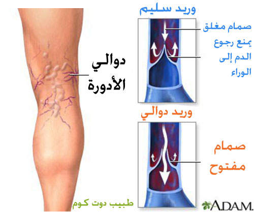 ����� ������ɡ ����� ������� Varicose veins 