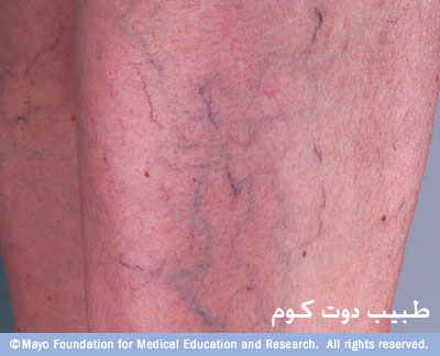 ����� ������ɡ ����� ������� Varicose veins 